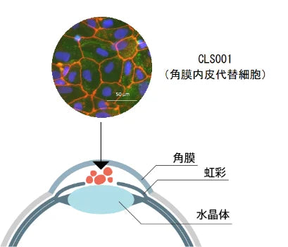 iPS細胞由来角膜内皮代替細胞（CLS001）の1例目の移植実施 ～短期安全性を確認、視力・角膜厚などの術後経過は改善傾向～